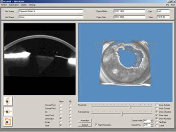 tomografia de cornea